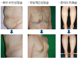 복부비말성형술, 유방재건성형술, 종아리퇴축술 사진