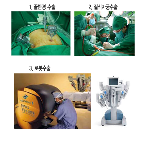 골반경 수술, 질식자궁수술, 로봇수술